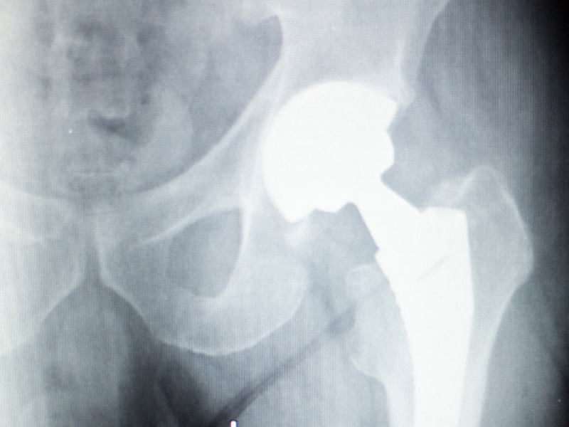 Ball and socket of the hip