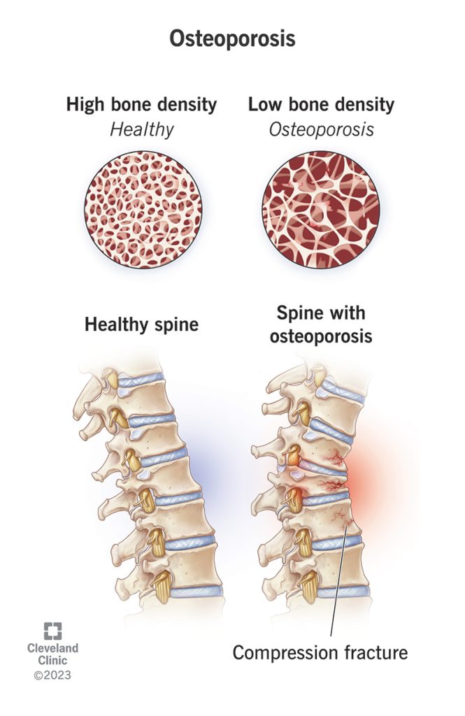 Osteoporosis