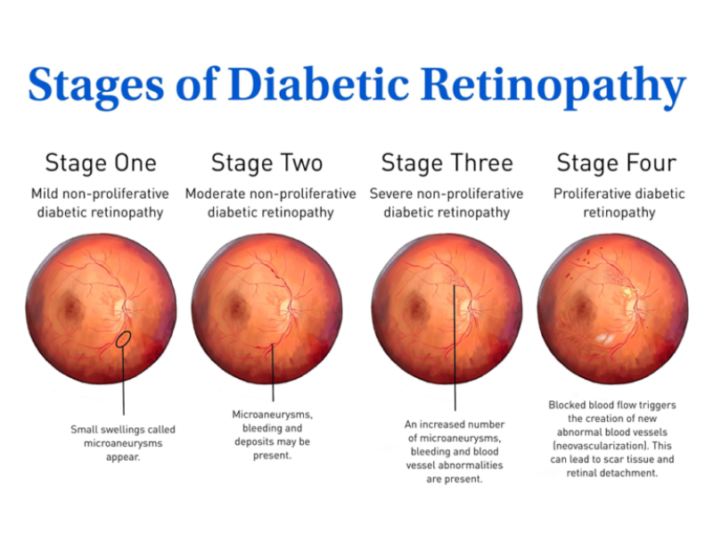 Diabetic Retinopathy stages